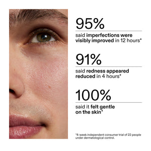 Close-up of a person's face with Succinic Acid Treatment application, showing improvement statistics from using Succinic Acid Treatment