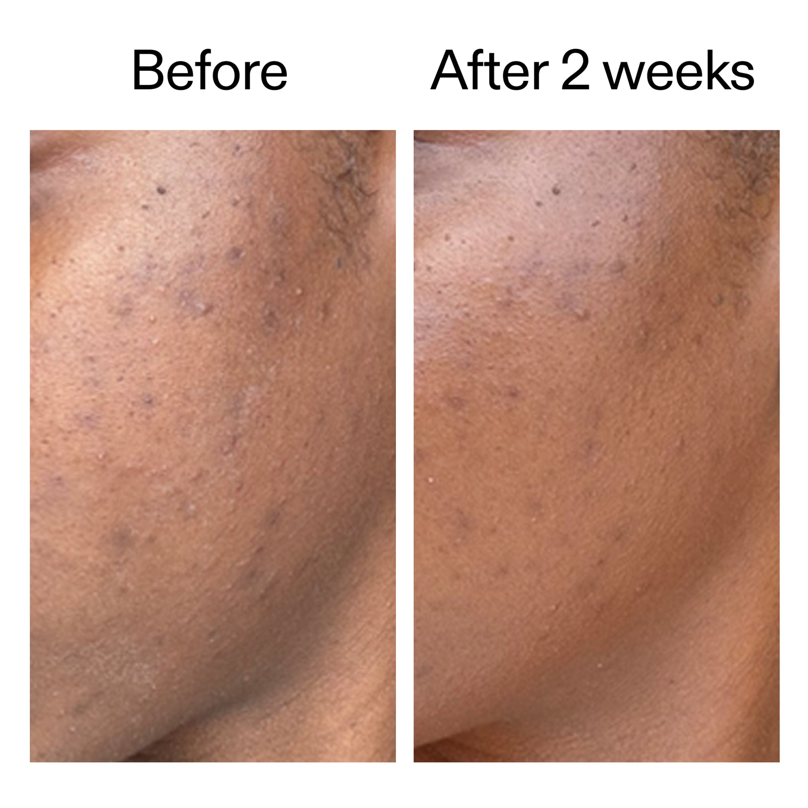 Before and after using 360° Skin Clearing Serum showing reduced blemsih marks