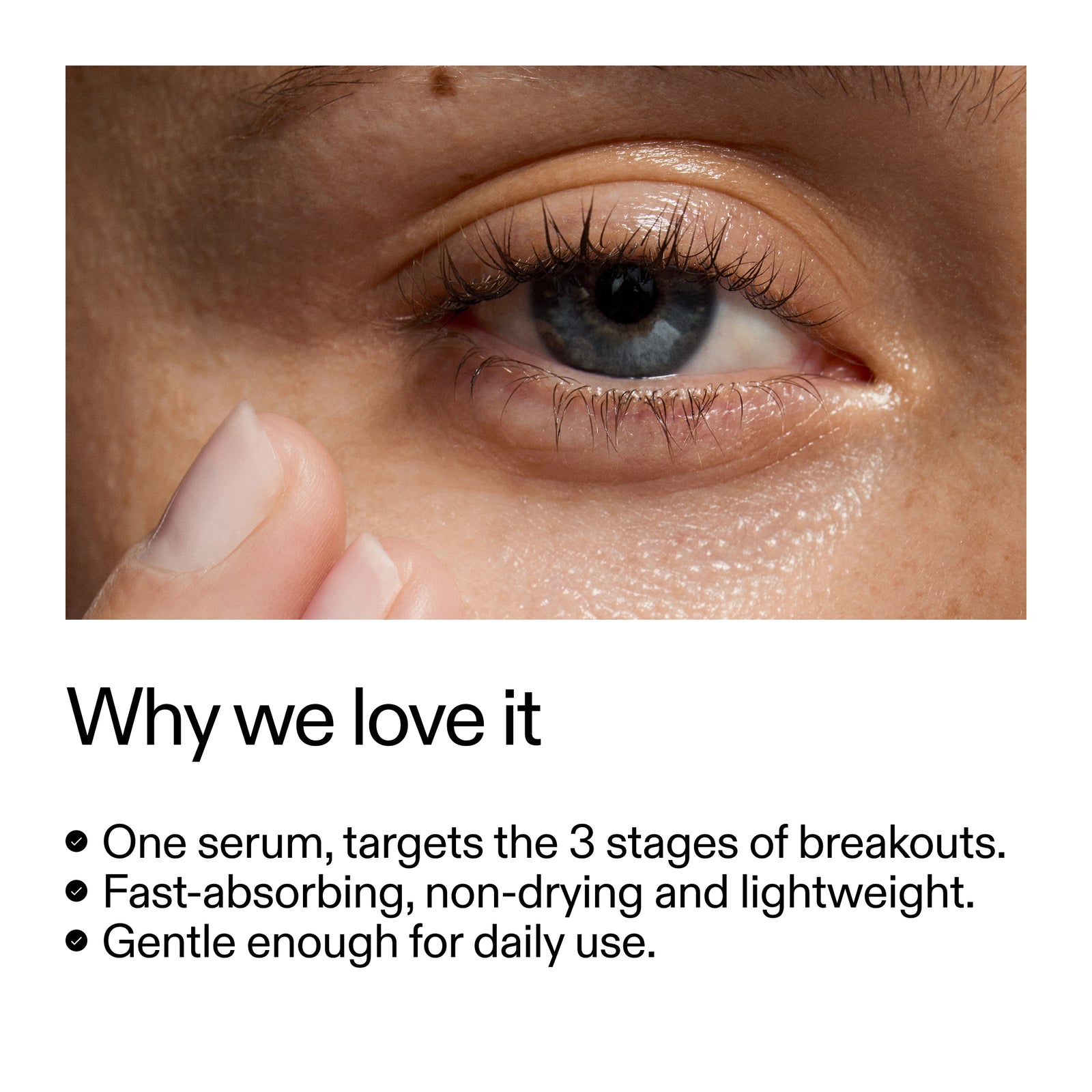 One serum, targets the 3 stage of acne. Fast-absorbing, non drying and lightweight. Gentle enough for daily use.