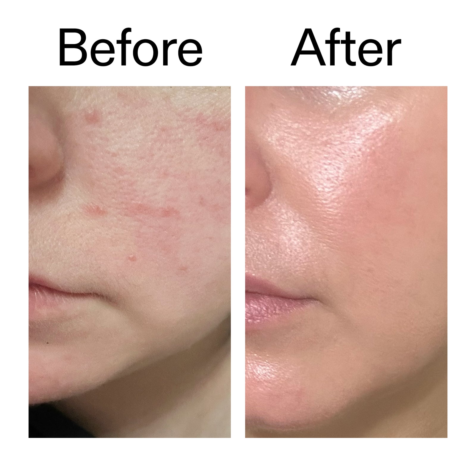 Before and after comparison of skin treatment on a person's face.