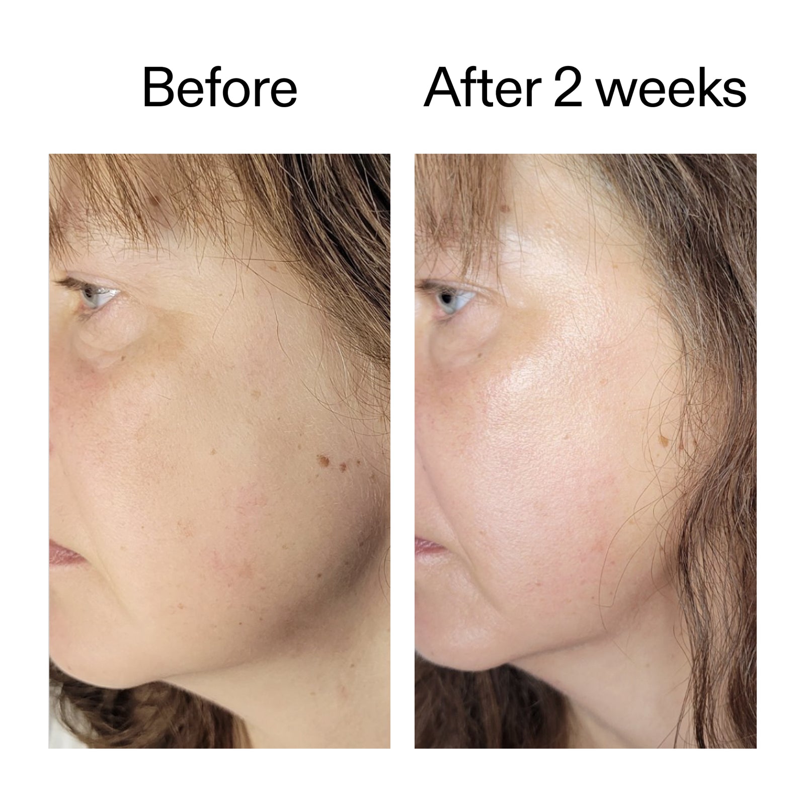Before and after comparison of a person's face with visible skin improvement over two weeks.