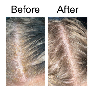 Before and after comparison of usingSalicylic Acid Exfoliating Scalp Treatment