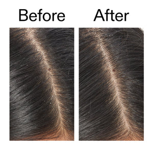 Before and after comparison of using Salicylic Acid Exfoliating Scalp Treatment