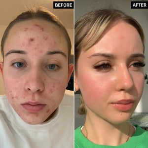 Before and After of customer using Tranexamic Acid Serum