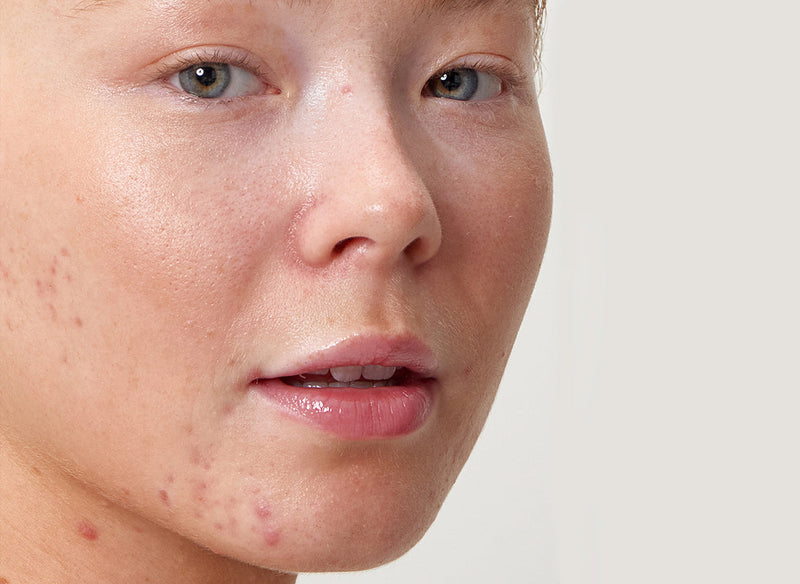 Model with acne on her chin 