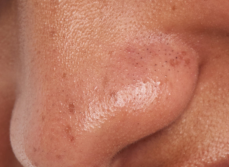Close up of blackheads on models nose