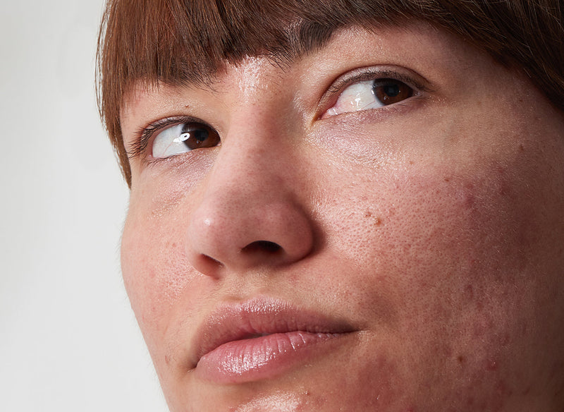 Close of up of acne on model