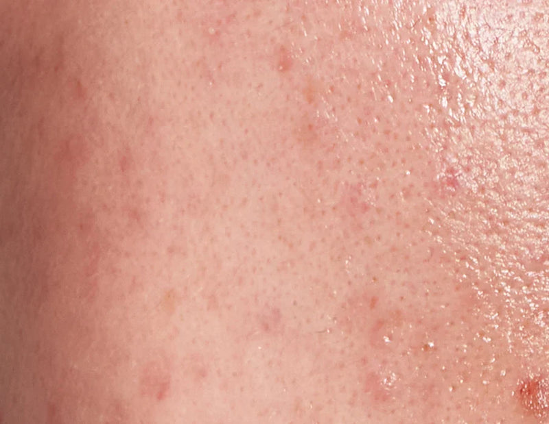 back acne close up