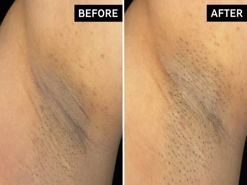 before and after armpit discolouration