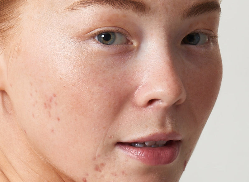 Model with acne looking directly at the camera
