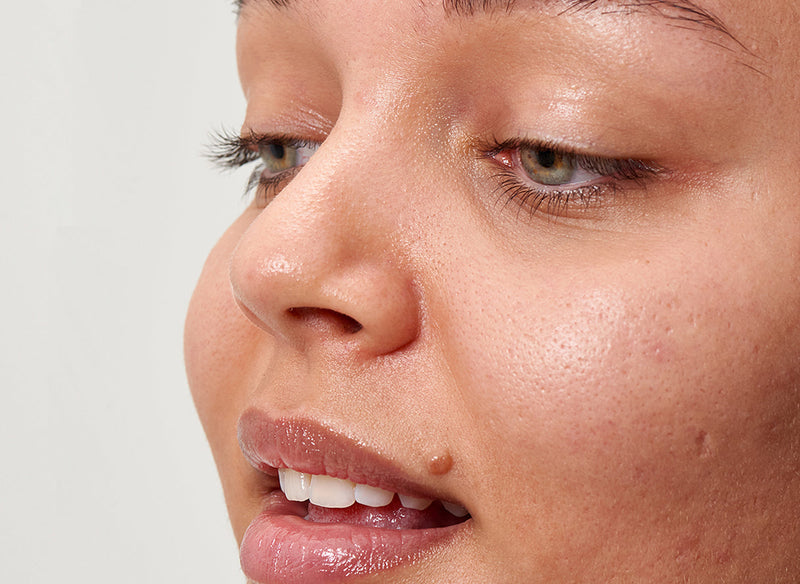 Hyperpigmentation 101 model blog cover