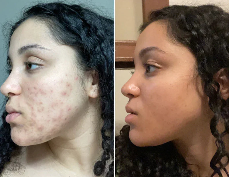 Before and after acne scars