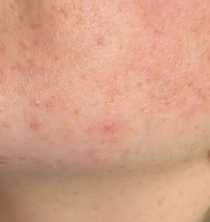 Does Azelaic Acid Cause Purging? What Your Skin Is Telling You