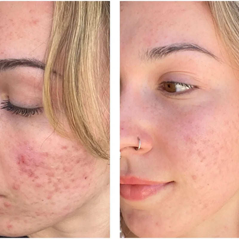 before and after of someone using azelaic acid for scars