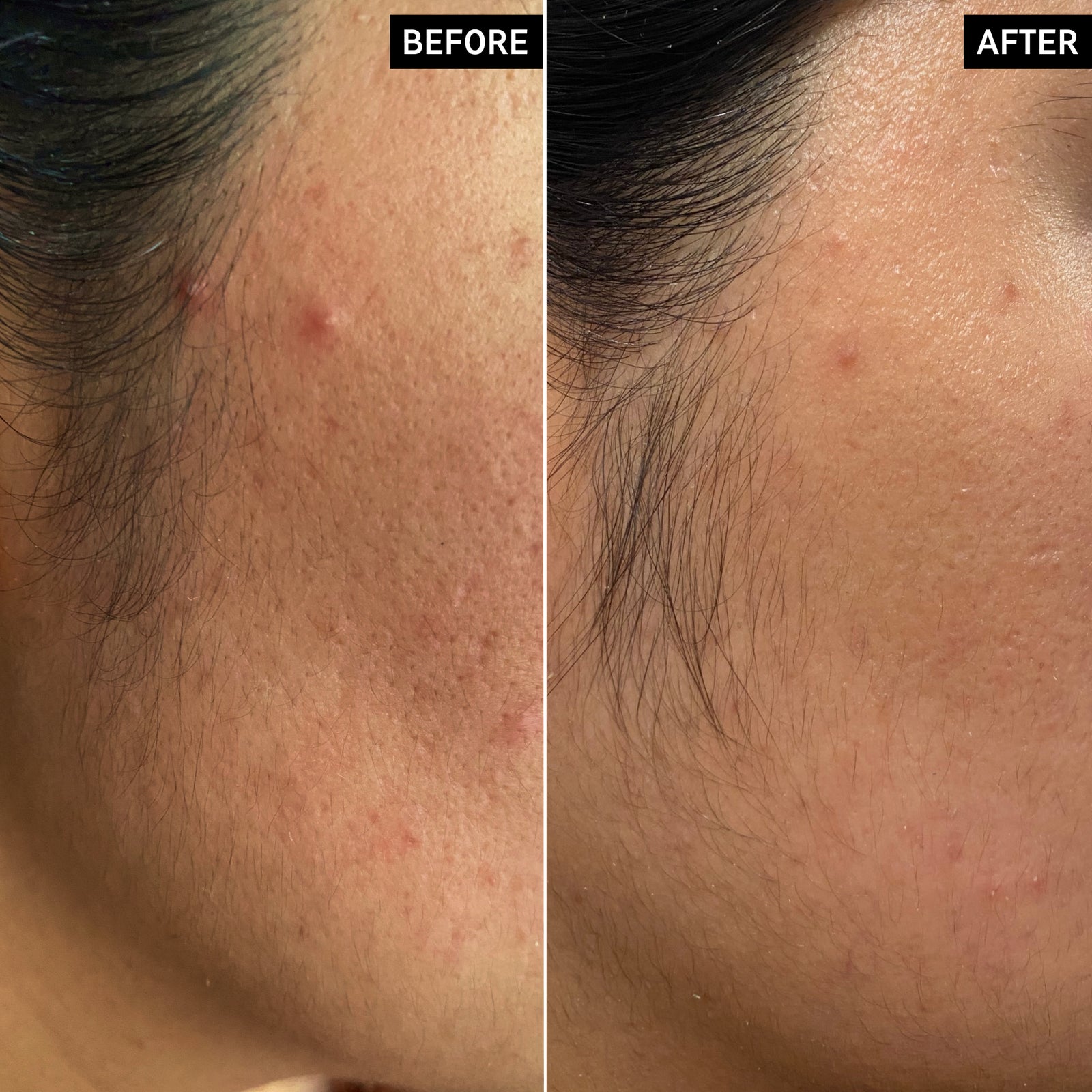 Before and after using Hydrocolloid Invisible Pimple Patches showing reduced blemish gunk