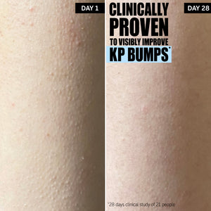 Clinically proven to visibly improve KP bumps*. The progress after 28 days of use.