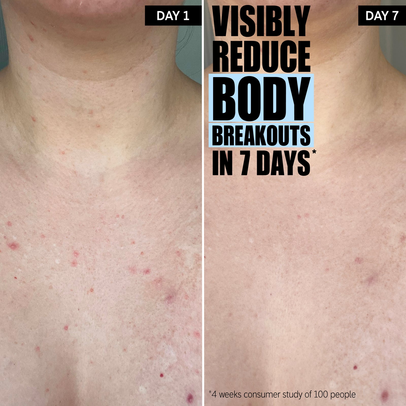 Visibly reduces body breakouts in 7 days*. The progress after use for 7 days.