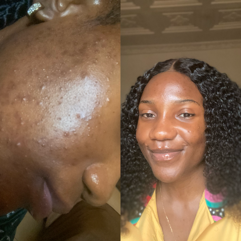 A split-screen before-and-after style comparison showing a woman's face. The left side shows severe acne, blemishes, and skin irritation on her forehead and cheek.