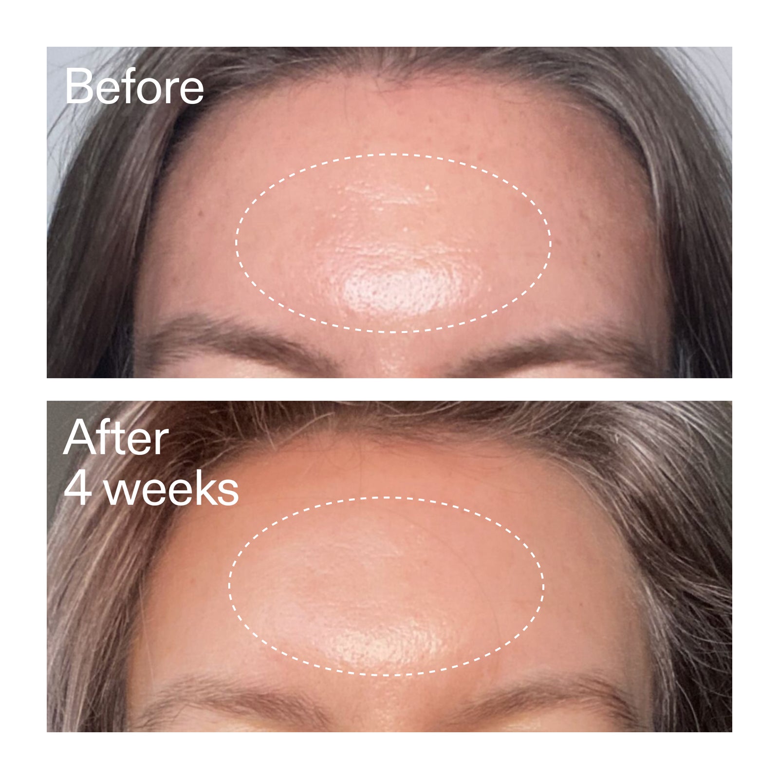 Before and after comparison of a skin treatment on a person's forehead.