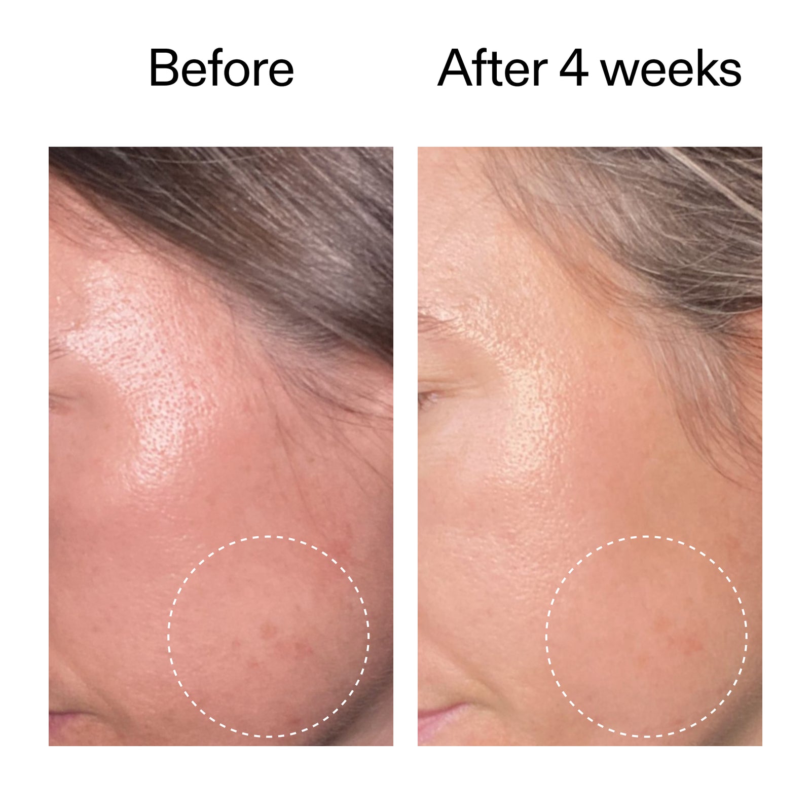 Before and after comparison of skin treatment on a person's face, showing reduced blemishes.