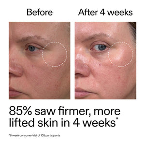Before and after comparison of skin treatment showing firmer, more lifted skin.