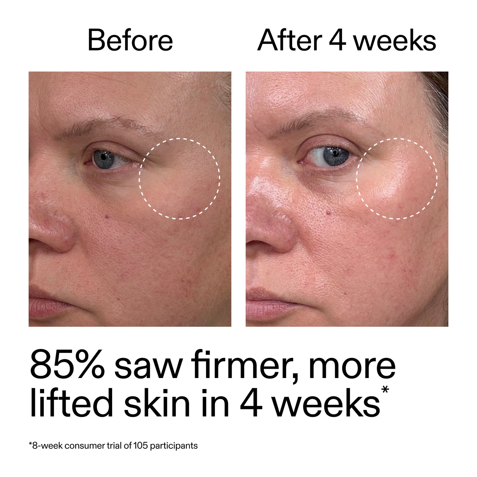 Before and after comparison of skin treatment showing firmer, more lifted skin.