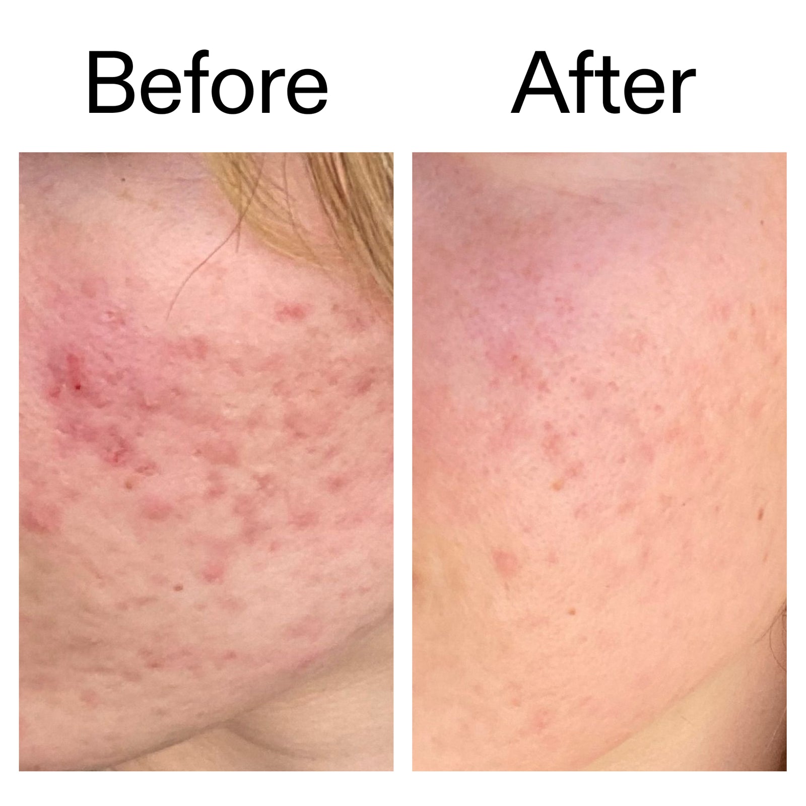 10% Azelaic Acid Serum for Redness Relief