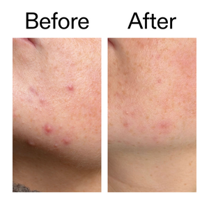 Before and after comparison of skin with acne on a white background