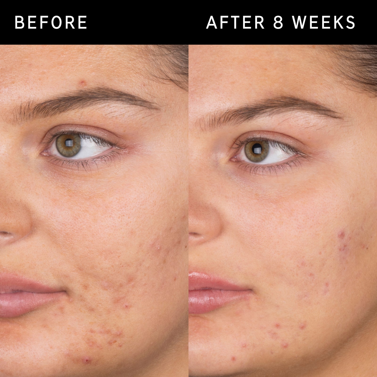 Before and after 8 weeks of using salicylic acid cleanser showing clearer and smoother skin