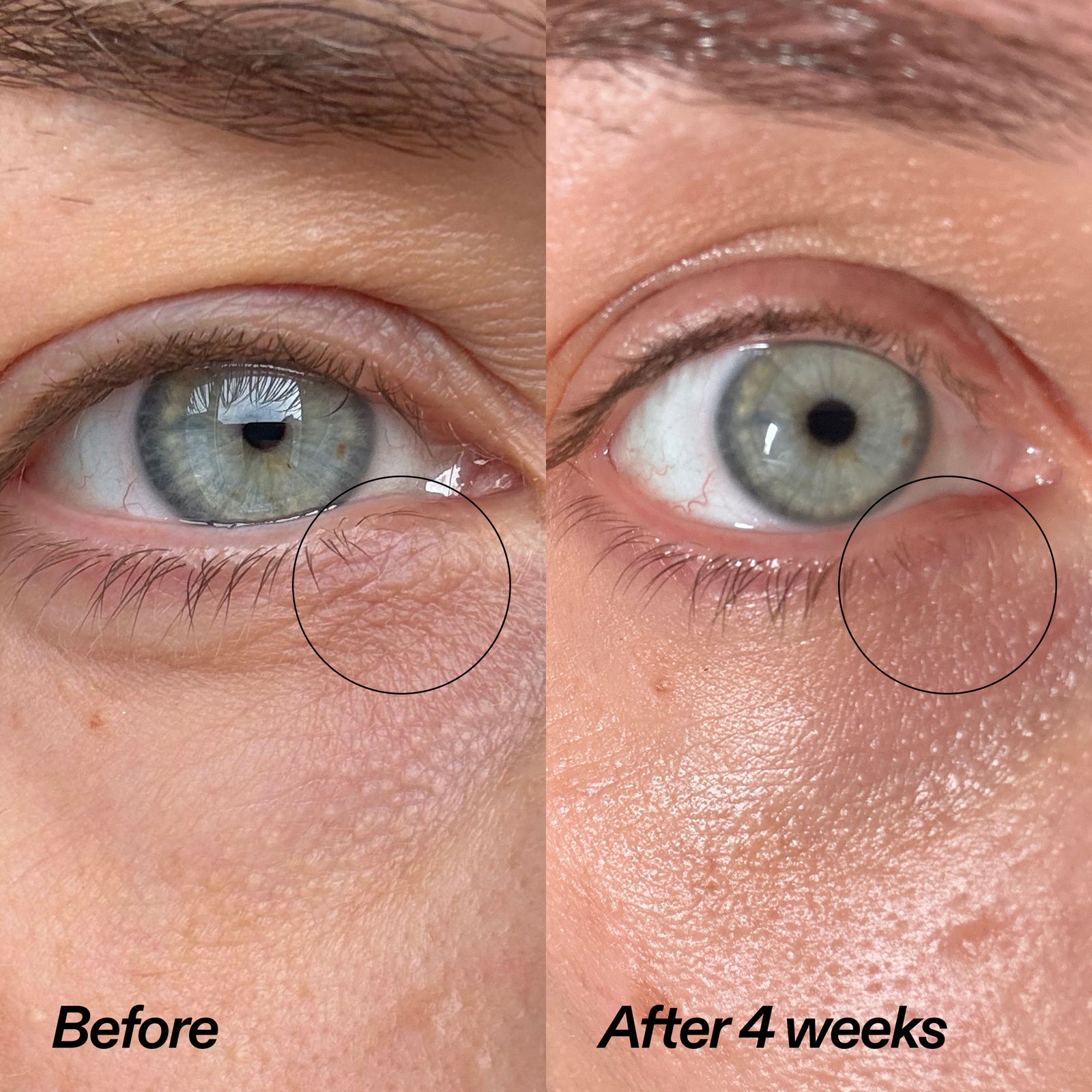 Side-by-side close-up of a human eye labeled 'Before' and 'After 4 weeks' with a circled under-eye area, showing skin texture improvement over time.