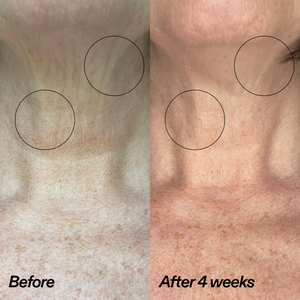 Before-and-after comparison of skin texture on the neck, showing visible wrinkles and hyperpigmentation in the left 'Before' panel and smoother, clearer skin in the right 'After 4 weeks' panel.