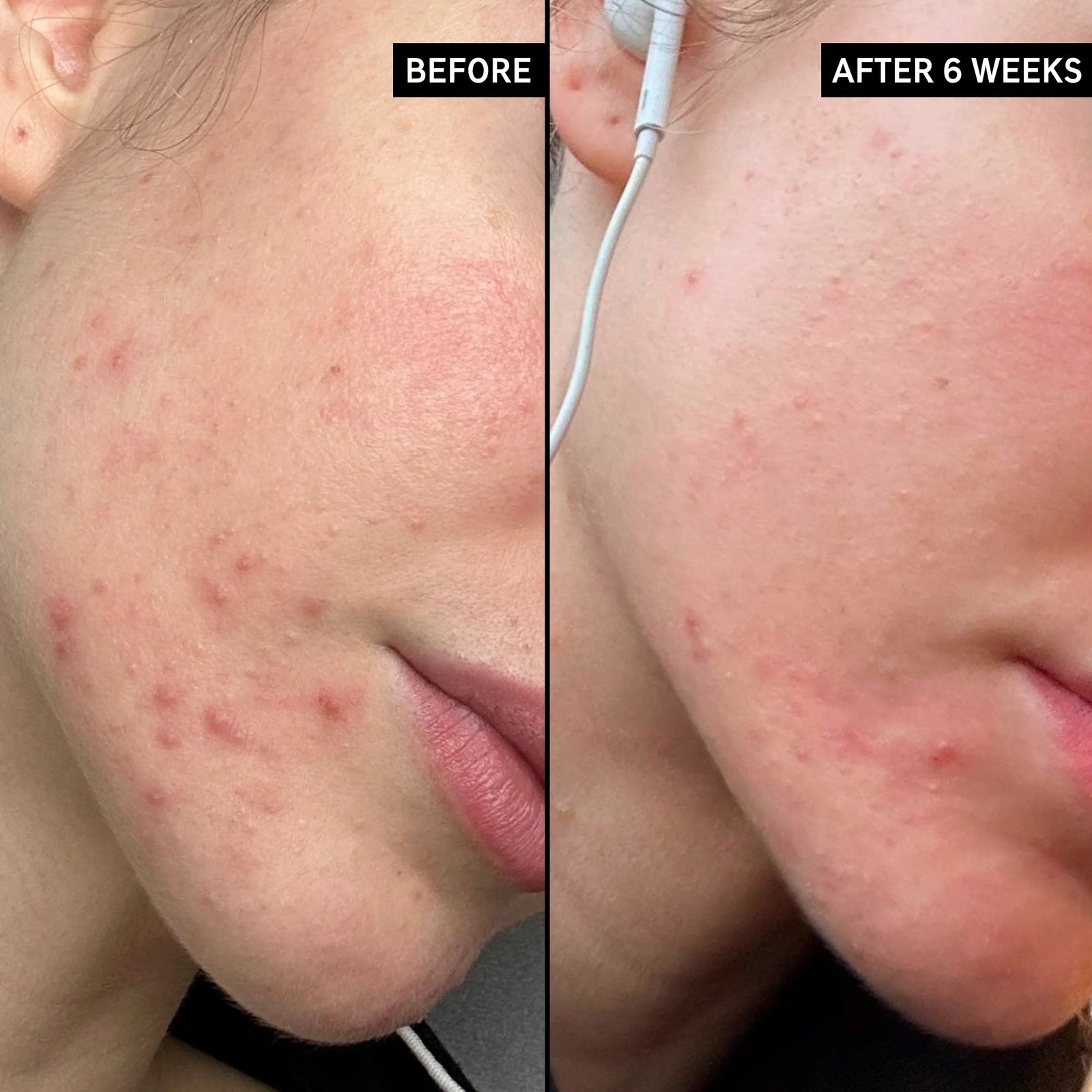 Before and after pictures of someone using Blemish Clearing Moisturizer after 6 weeks