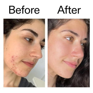 Before and after comparison of a person's face with acne on the left and clear skin on the right.