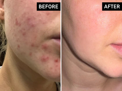 Before and after comparison of acne-prone skin on a person's face.