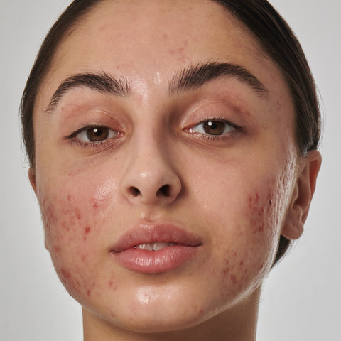 Model with post acne scarring
