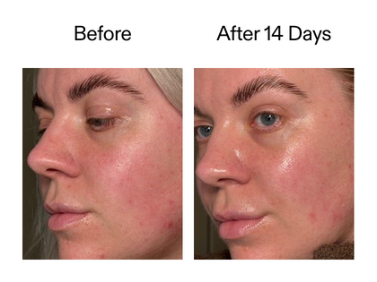 Before and after comparison of a person's face with acne, showing improvement after 14 days.