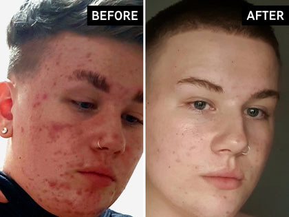 Before and after using Salicylic acid cleanser