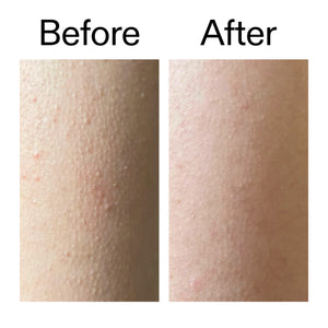 Before and after comparison of someone using  Glycolic Acid Exfoliating Body Stick on their KP bumps