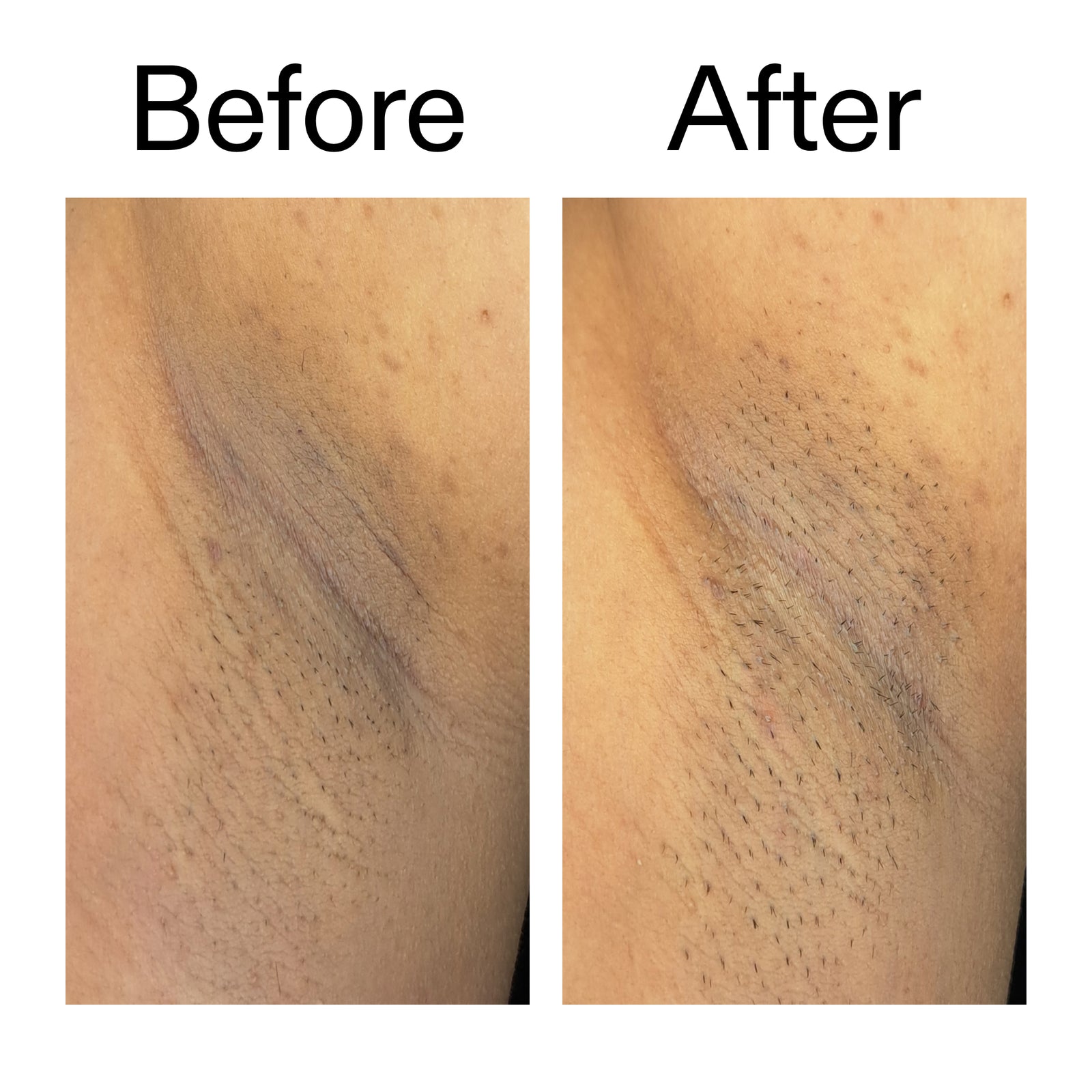 Before and after comparison of someone using Glycolic Acid Exfoliating Body Stick on their armpit
