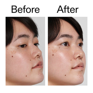 Before and after comparison of a person's face with visible skin treatment results.