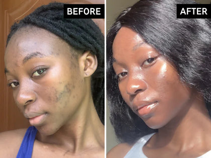 Before and after comparison of a woman's face with visible skin concerns.