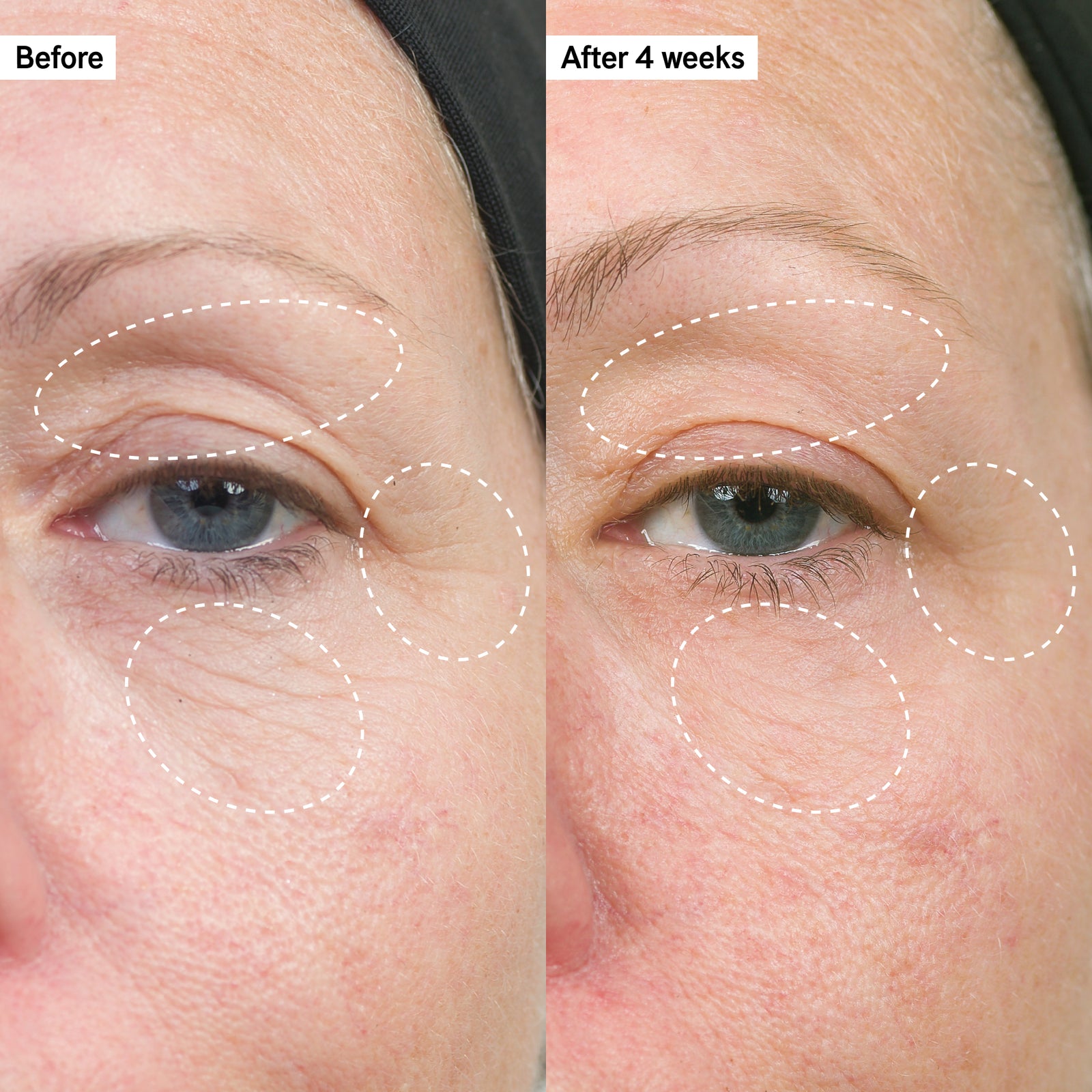 Before and after showing firmer and lifted skin on the eye