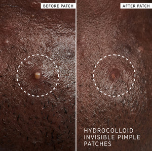 Before and after of customer using Pimple Patches