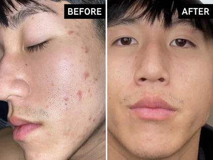 Before and after comparison of a person's face with acne on the left and clear skin on the right.