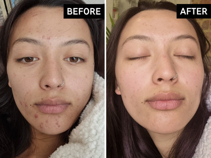 Before and after comparison of a person with acne on their face.