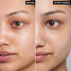 Before and After using Caffeiene Eye Cream for 6 weeks