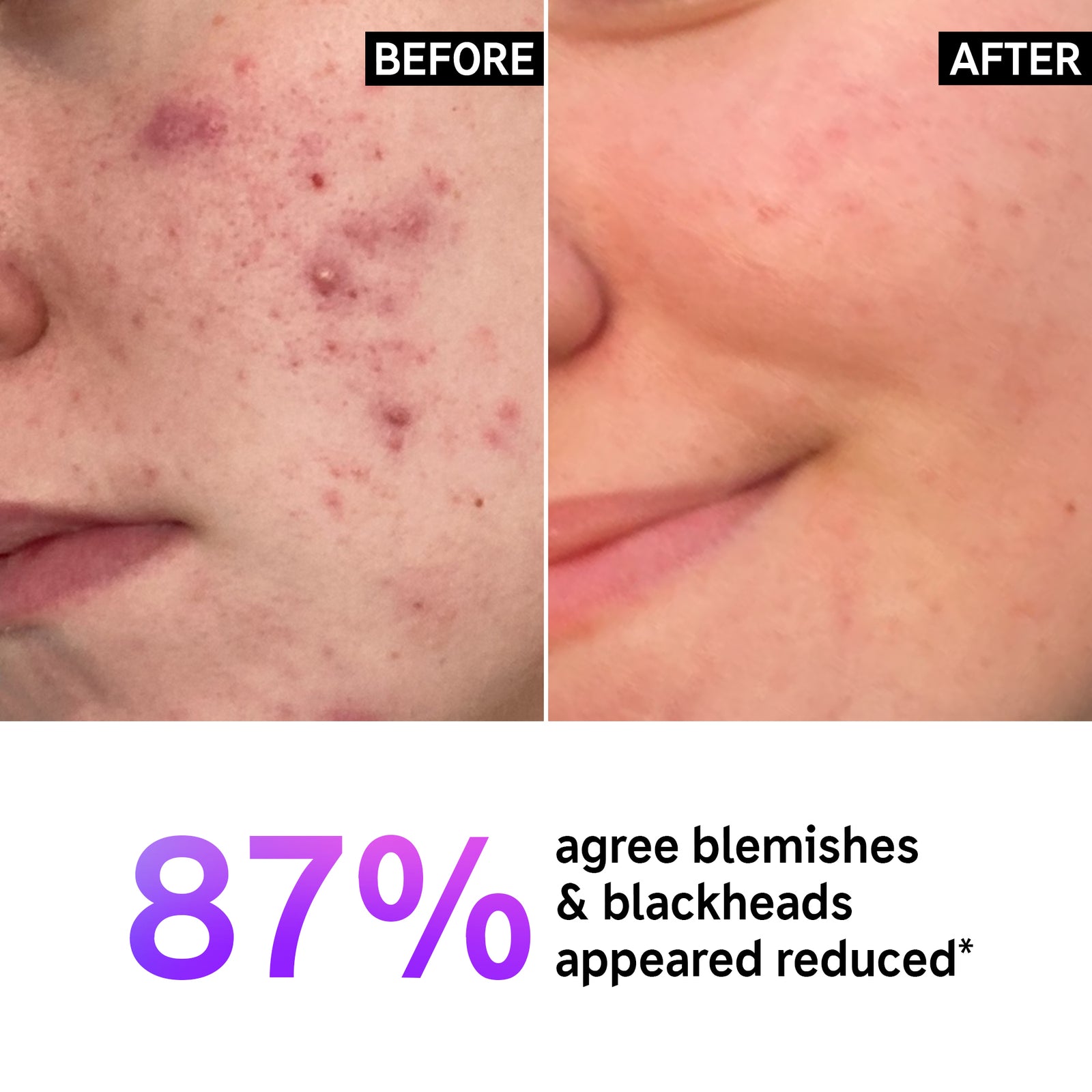 Before and After image of using Supersize Salicylic Acid Cleanser, with the statistic 