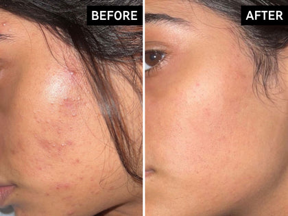 Before and after comparison of a person's face with visible skin improvement.