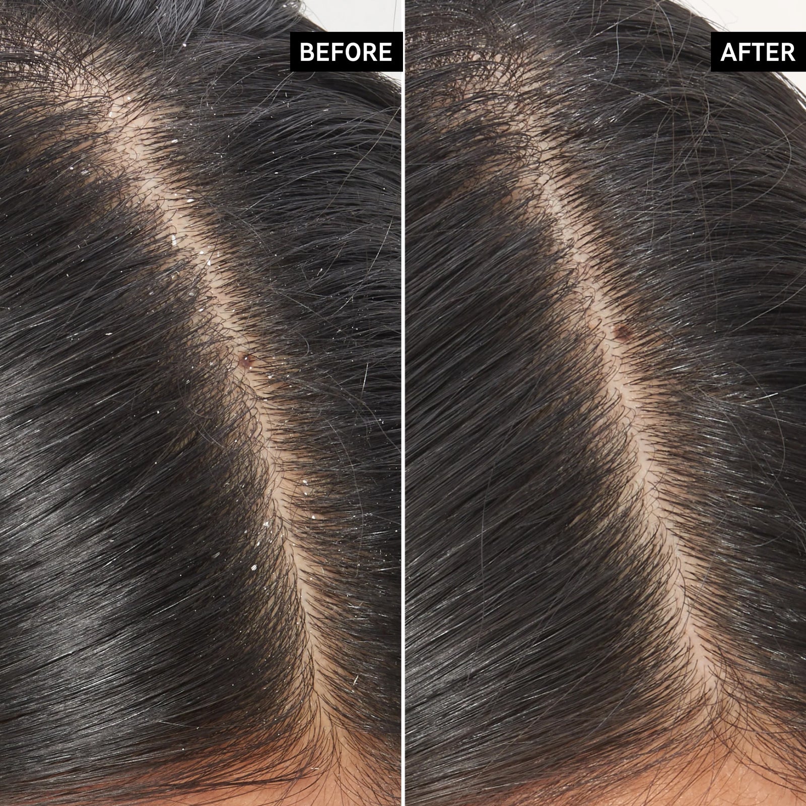Before and after using salicylic acid scalp treatment