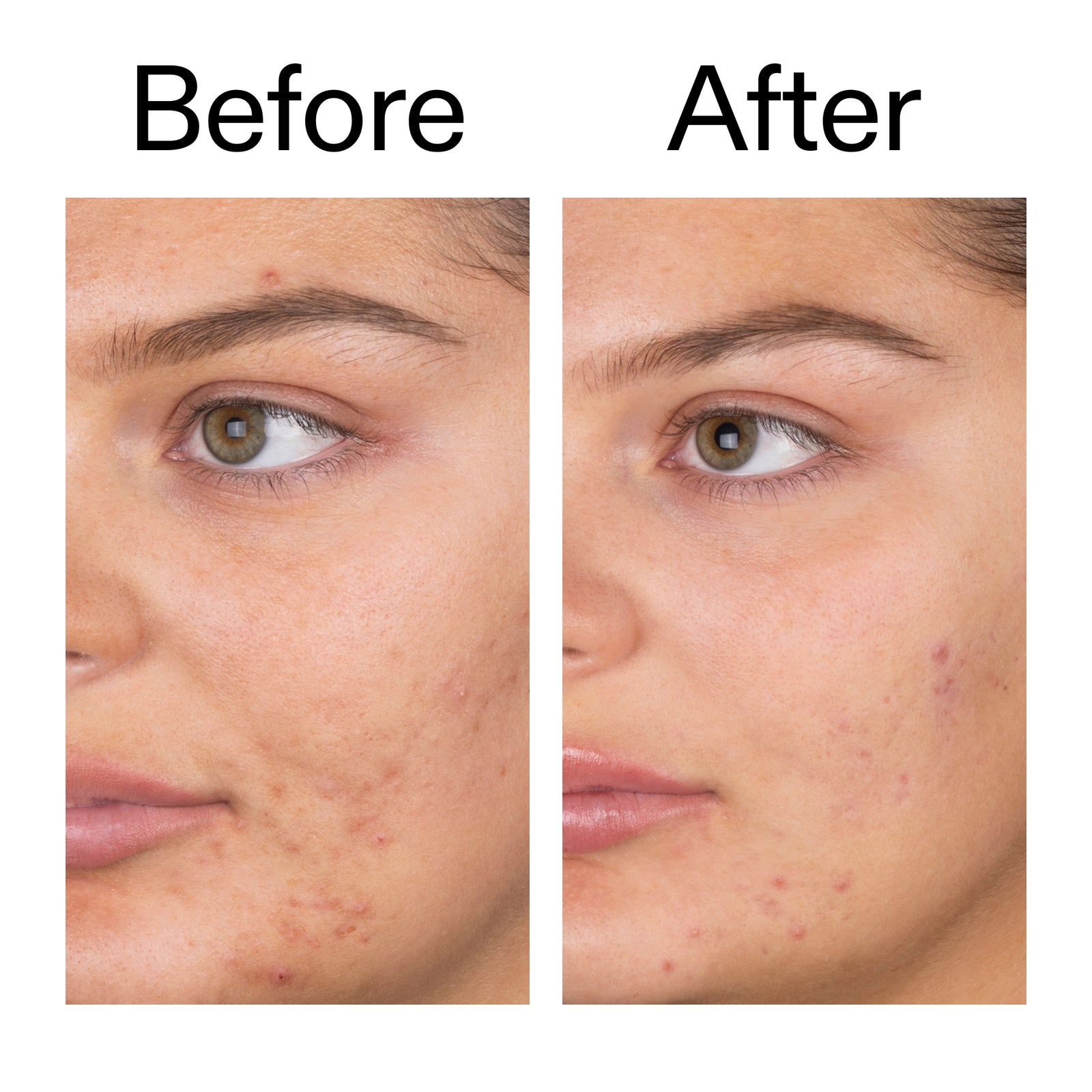 Before and after using Salicylic Acid Cleanser